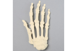 Rheumatoid arthritis hand models help residents and patients understand how the disease severely affects the bones and joints of the hand.