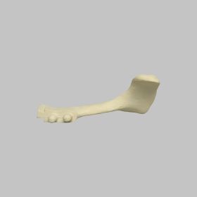 Acromion Replacement for 1509 Shoulders