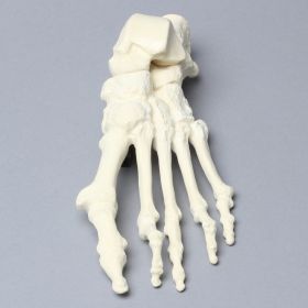 Foot with Hammertoes, Bunions, and Heel Spur