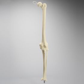 Knee Replacement with Tibia and Fibula