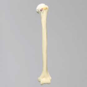 Humerus Replacement with Hill-Sachs Lesion