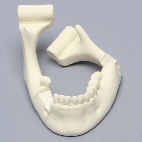 Mandible with Bilateral Fractures