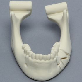 Mandible with Comminuted Fracture