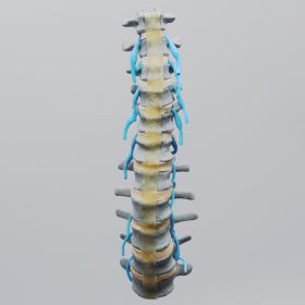 Spine, Lumbar, Osteoporotic Vertebrae with Nerve Roots, Radiopaque