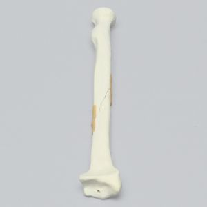 Radius with Long Oblique Fracture, 5.5mm Canal, Solid Foam