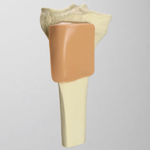 Tibia with Skin Patch, Proximal