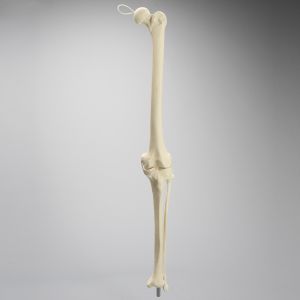 Knee Replacement with Tibia and Fibula