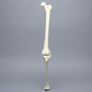 Knee with Erosion and Three Stretch Cord Ligaments, Full Length