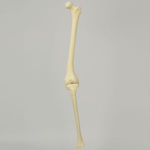 Knee with Distal Femur 10 Degree Valgus Deformity