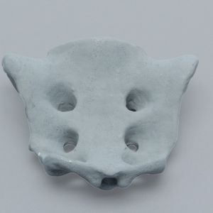 Sacrum, Radiopaque