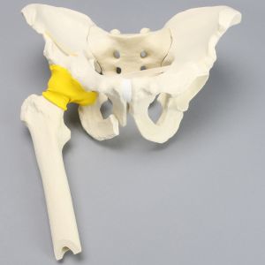 Pelvis with "T" Fracture, Displacement, and Encapsulated Femur, Full Male