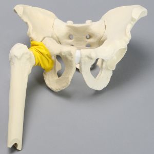 Pelvis with Acetabular Fractures, Fragment, and Femur, Full Male