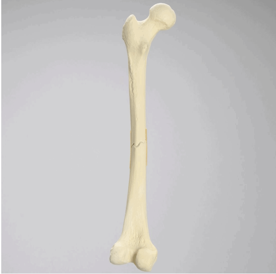 Femur with Transverse Fracture, Foam Cortical, Left, Small