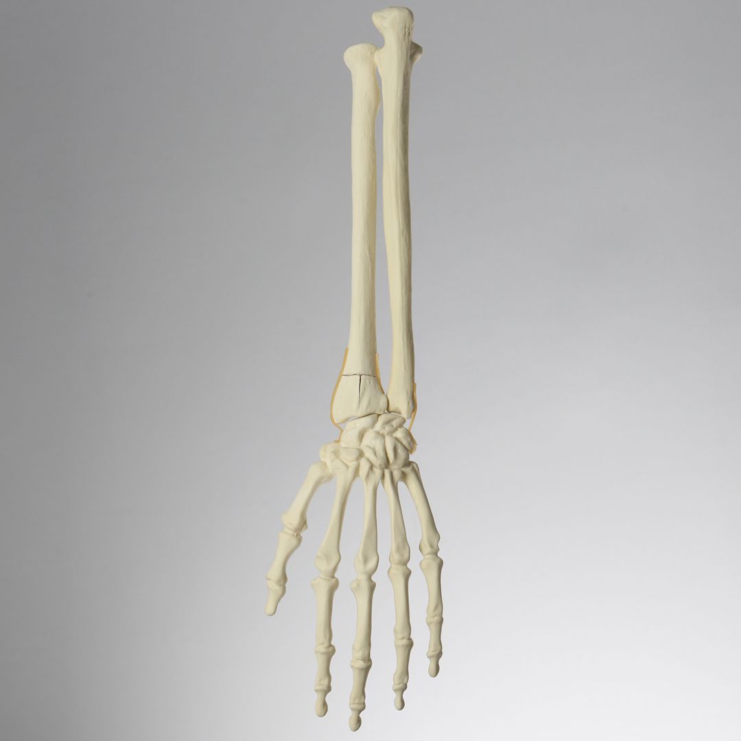 Hand and Wrist with Three-Part Fracture, Foam Cortical
