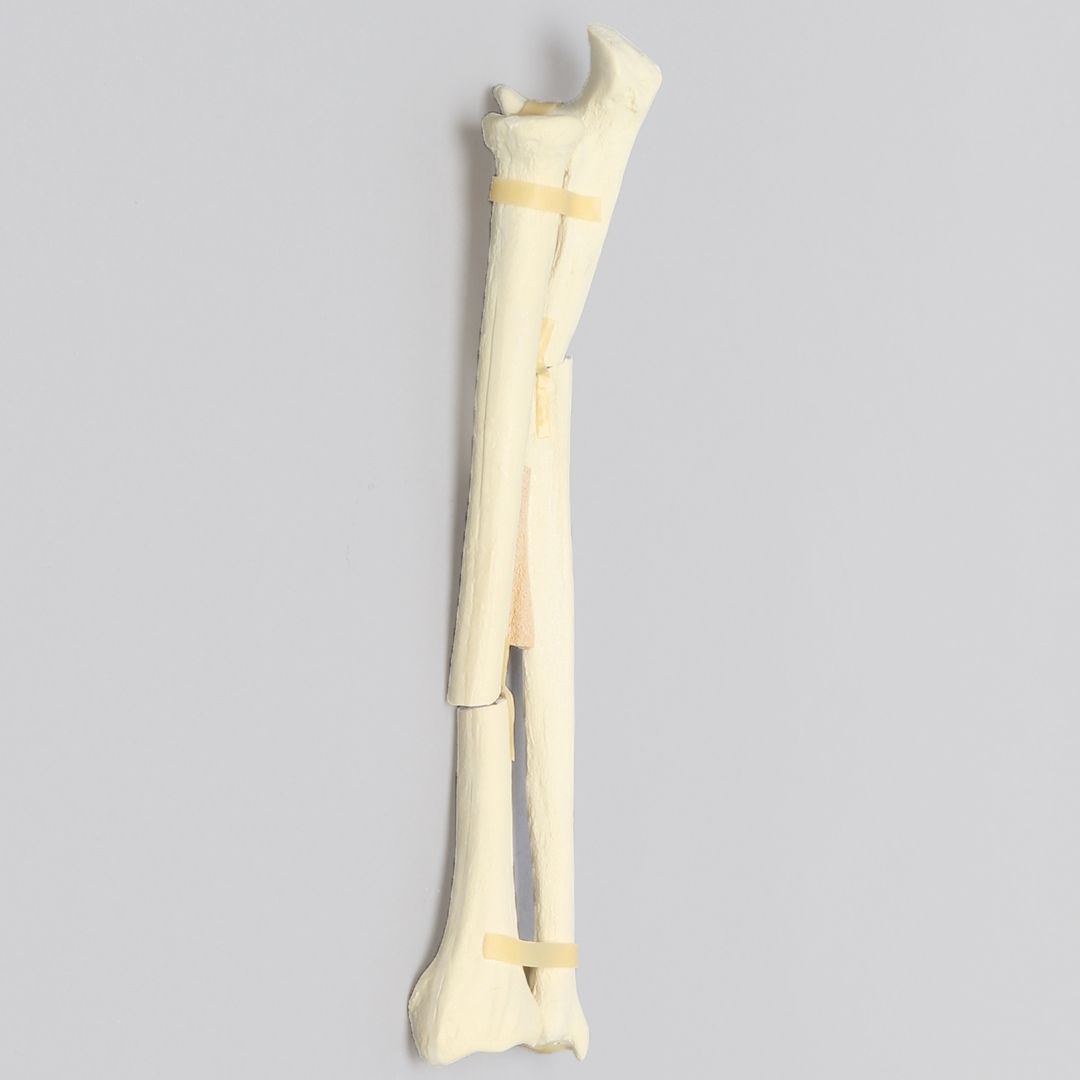 Ulna and Radius with Oblique and Transverse Fractures, Foam Cortical