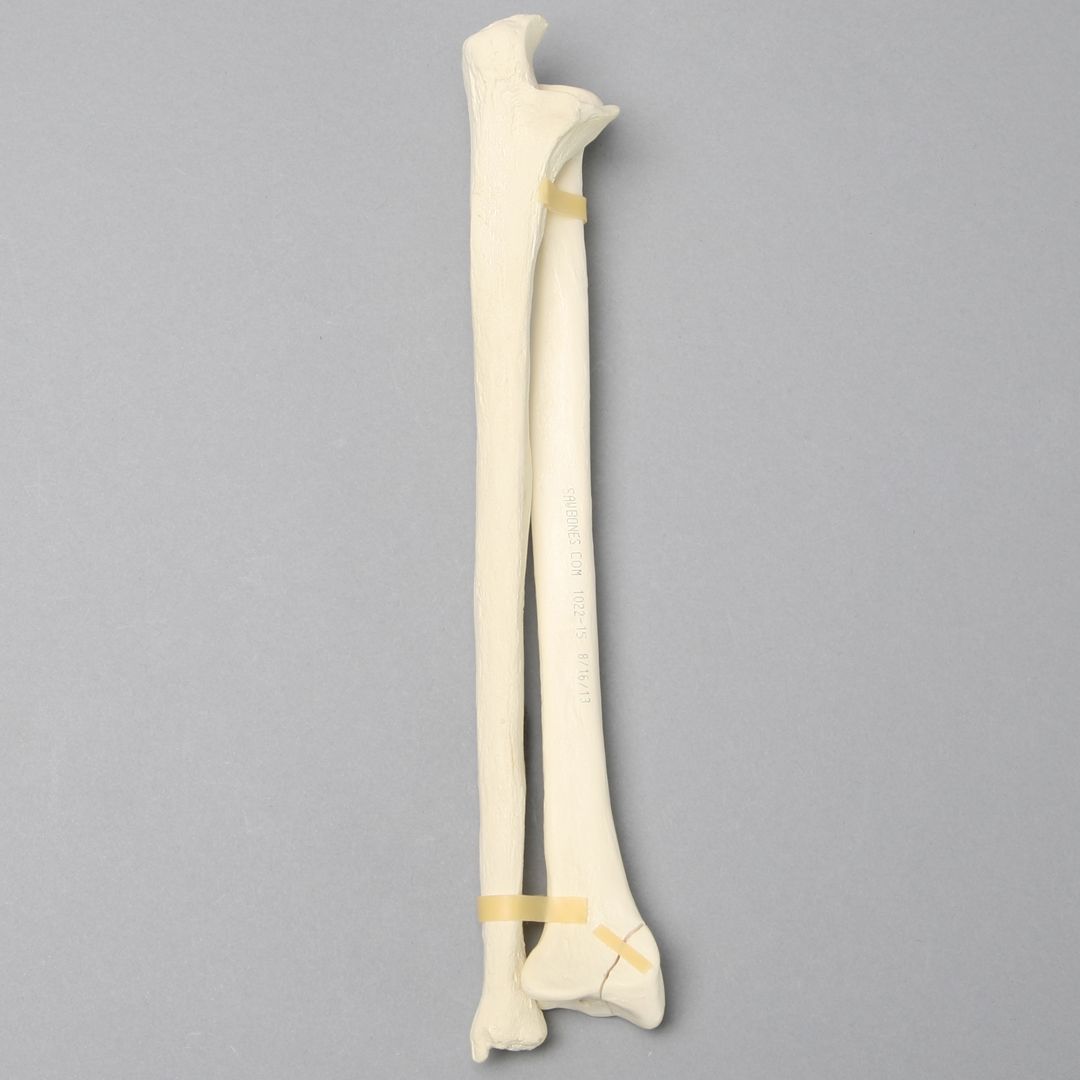 Ulna and Radius with Styloid Fracture, Foam Cortical