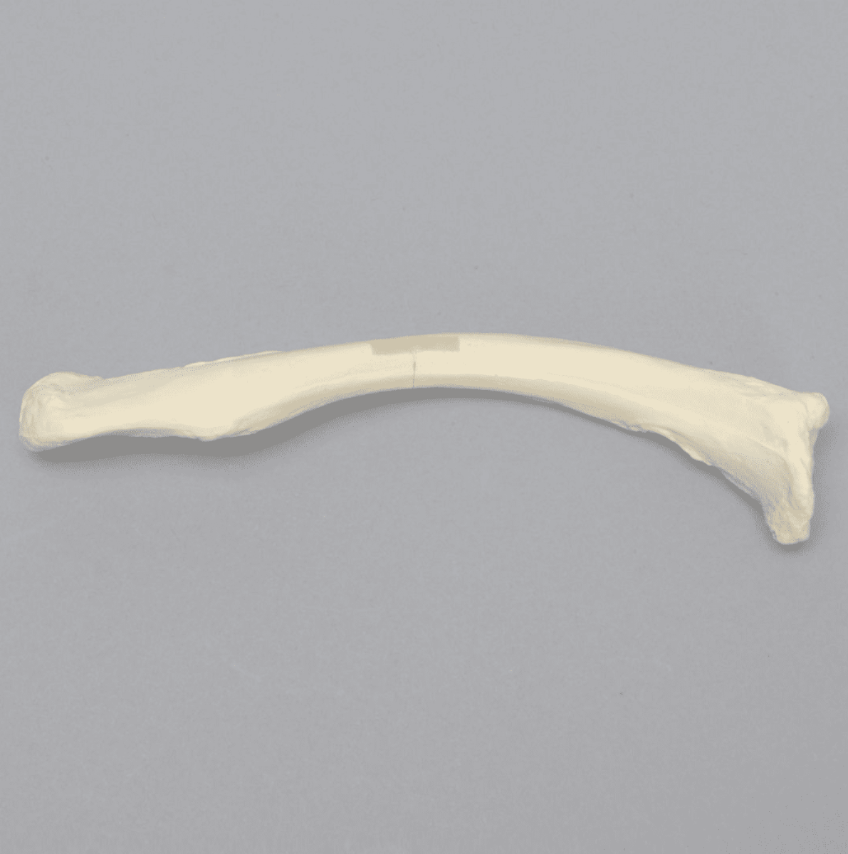 Clavicle with Transverse Fracture, Solid Foam